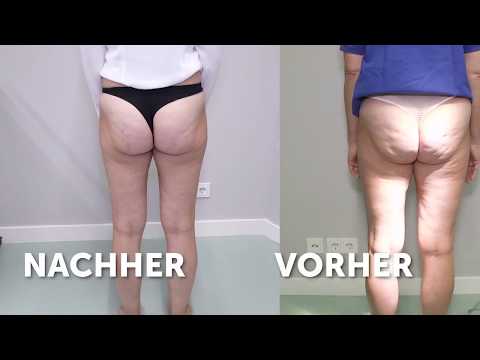 Cellulite Behandlung mit Cellfina bei Medical One - video from MediDate