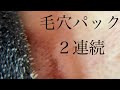毛穴パック２連続！マイクロスコープもあるよ
