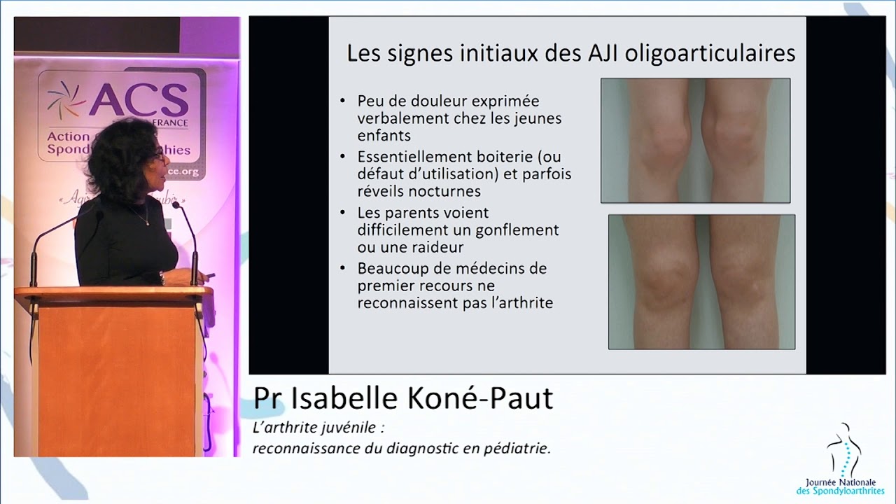 JNS 2019 - Pr. Isabelle Koné-Paut, Rhumato-pédiatre - l'Arthrite juvenile