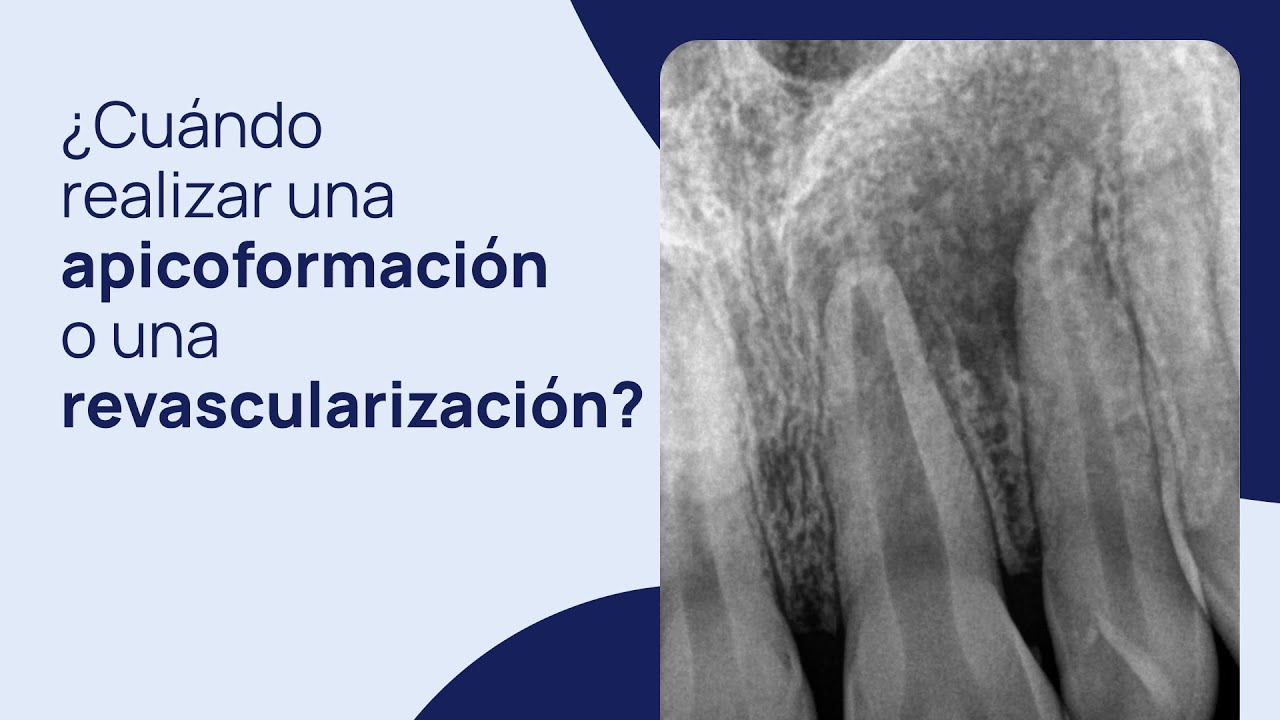 ¿Cuándo realizar una apicoformación o una revascularización?
