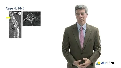 AOSpine Thoracolumbar Classification System