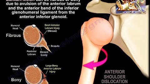 Shoulder Dislocation Anatomy - Everything You Need To Know - Dr. Nabil Ebraheim