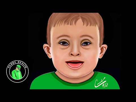 Down syndrome - Trisomy 21: Patient Education