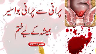 Hemorrhoid & Piles Ka Wazifa, Bawaseer Ka Ilaj | Health Tips in Urdu/Hindi | Shehzad Turabi