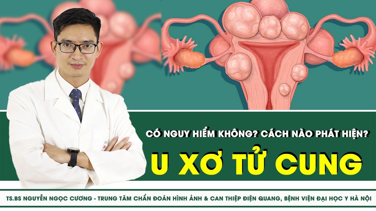U xơ tử cung có nguy hiểm không? cách nào phát hiện? | SKĐS