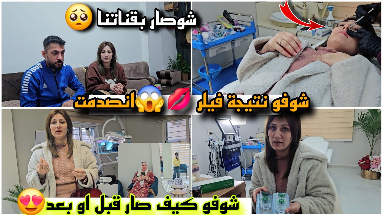 شوفو نتيجة فيلر 💋انصدمت شوفو قبل او بعد 😱//شوفو صار بقناتنا😞