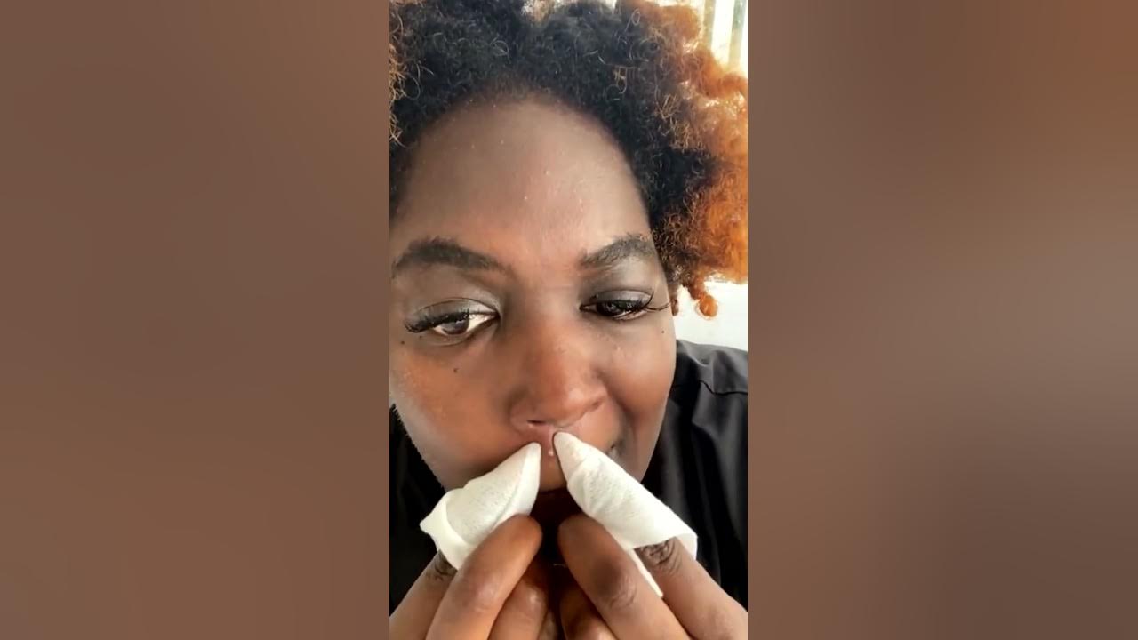 Huge blackheads extraction Pimple popper blackhead on face YouTube