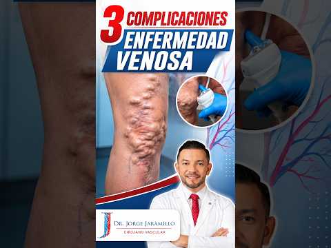 3 complicaciones de las várices que no debes ignorar
