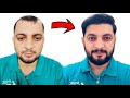 My 6 months hair transplant journey  best hair transplant results  case study after 180 days