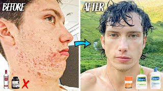 My ACNE Skincare Routine &amp; Diet for CLEAR Skin | How to STOP ACNE for 2023
