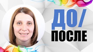 #21 случай до/после. Открытый прикус исправление, установка имплантантов, коронка на имплантант.