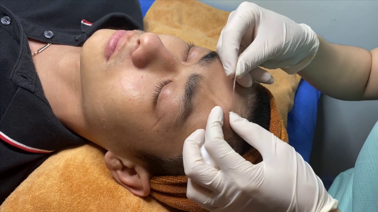 Get hidden acne, clean pores for handsome brother thuytruong#32