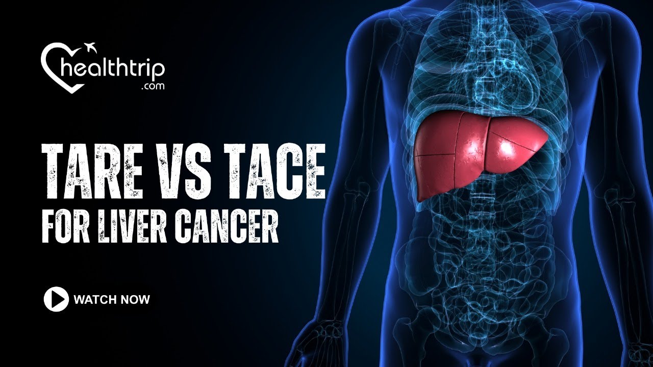 Tace Vs Tips TARE vs. TACE for Liver Cancer | #livercancertreatment #livercancer # ...