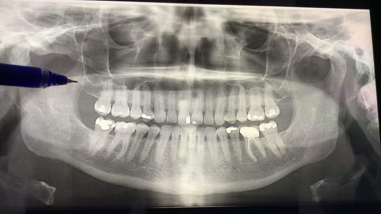 شرح مختصر لتقرأ ال OPG