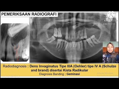 Journal Reading Dental Radiology- Dens Invaginatus (Deratih Putri Utami AF-04074881820007)