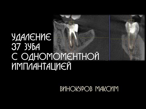 Удаление 37 и одномоментная имплантация. Винокуров Максим.