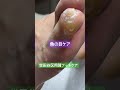 【魚の目ケア】世田谷区用賀フットケア#フットケア #用賀 #魚の目