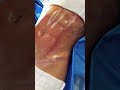 ANTES E DEPOIS DE UM ABDÔMENC OM LIPO HD Dr. Ícaro Samuel #lipohd #abdomentrincado