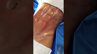 ANTES E DEPOIS DE UM ABDÔMENC OM LIPO HD Dr. Ícaro Samuel #lipohd #abdomentrincado