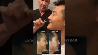 Amazing Asian Rhinoplasty Results Revealed Just 7 Days After Surgery