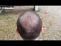 Fue hair transplant timeline i day 1 to day 365 i before  after