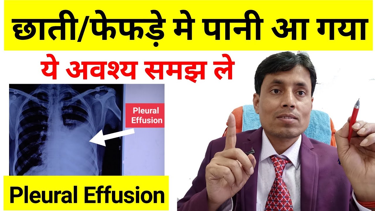 Pleural Effusion In Hindi Chhati Me Pani Bhar Jana Pleural pleural-effusion-in-hindi-chhati-me-pani-bhar-jana-pleural