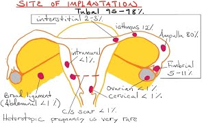 Ectopic pregnancy | Methotrexate indications | screenshot 2