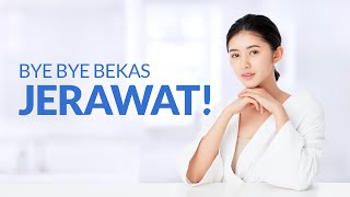 Beragam Cara Menghilangkan Bekas Jerawat