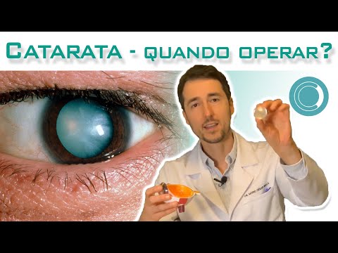 Catarata - quando operar?