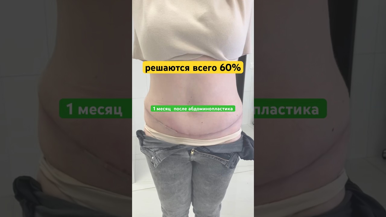 #абдоминопластика #пластическаяоперация