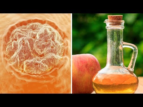 How to Remove Warts at Home Using Apple Cider Vinegar