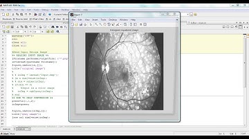 SD IEEE IMAGE PROCESSING DIABETIC RETINOPATHY DETECTION IN FUNDUS IMAGES