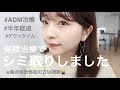 【シミ取り経過レビュー】約1万円でレーザーあててもらえました🌸