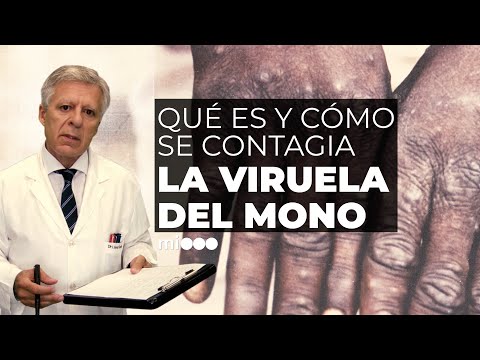 Confirman el primer caso de viruela del mono en Mendoza 3 ¿QUÉ ES y CÓMO SE TRANSMITE la VIRUELA del MONO? - #TFN