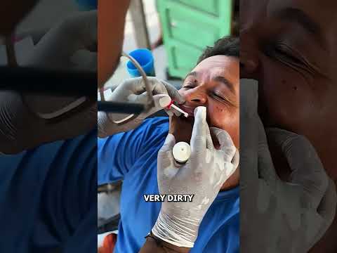 This Patient Came With Super Dirty Teeth See What I Did😬🦷✨😲