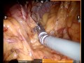 Robotic Sleeve Gastrectomy (Un-edited)