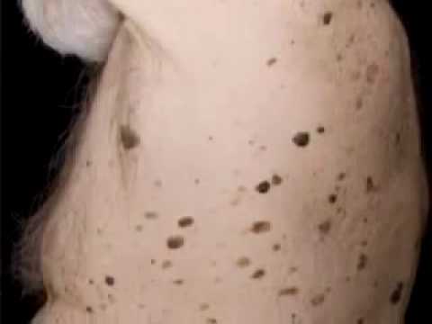 Dermatosis papulosa nigra - Huidarts.com