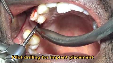 Upper premolar & molar replacement with basal implant