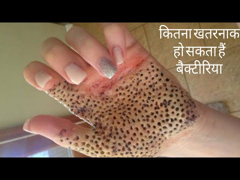 वीडियो: सूक्ष्म रूप से घायल बैक्टीरिया क्या है?