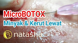 Laser Flek Natasha Skincare | on the spot NSCC Sidoarjo