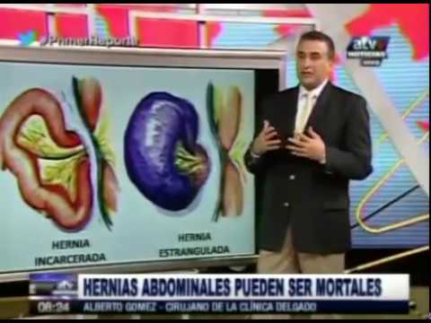 Vídeo: Hernia Incisional: Causas, Síntomas, Tratamiento, Foto