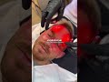 HydraFacial Treatment in New York | Instant Skin Glow at Enfield Royal Clinic NYC