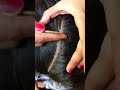 #fypviralシ #statisfying #lice #hair #LiceOnHead #liceremoval #brasil #xyzbcafyp #licecomb #kutu