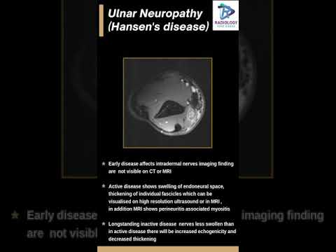 Hansen&rsquo;s disease#Ulnar Nerve thickening#Ulnar neuritis#mri ulnar nerve#nerve thickening.