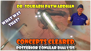 165 Posterior zonular dialysis-Dr Sourabh Patwardhan-not peripheral PC rupture or complete dialysis
