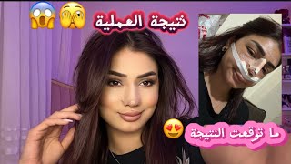 واخيرااا !! 😍نتيجة عملية الانف 😱🥺وما توقعت شكلي يطلع هيك 😱وشلنا الخرطومين يلي بالانف😱🥺