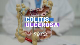 ¿Dolor abdominal, diarrea persistente o sangrado? Podrían ser señales de colitis ulcerosa.