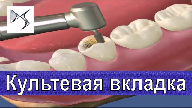Как изготовить культевую вкладку Что такое культевая вкладка ...