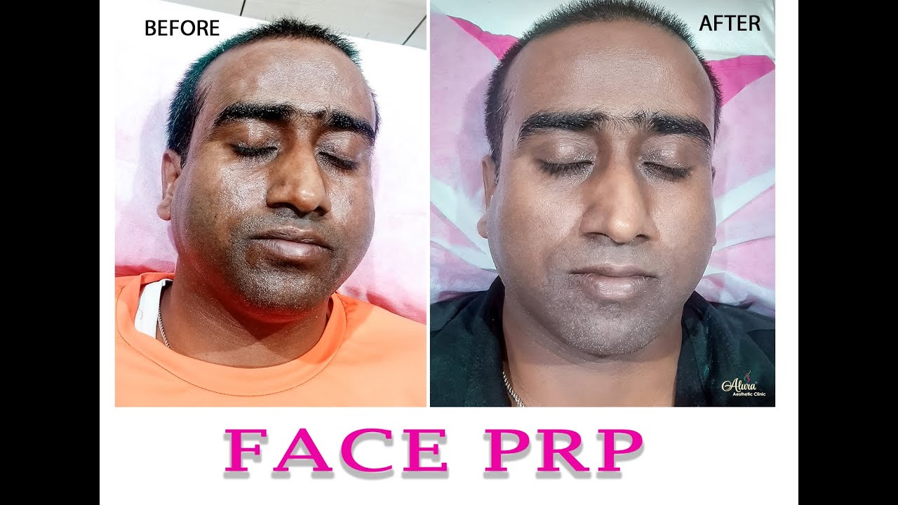 Face PRP Skin Treatment Best Skin Care Clinic Kolkata Alura