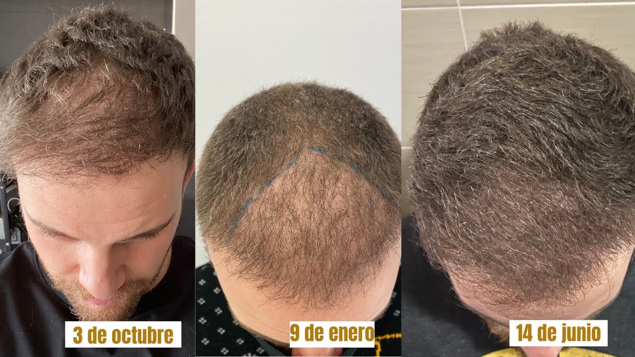 EVOLUCIÓN DE MI CABELLO TRASPLANTADO TRAS SABER QUE TENGO LIQUEN PLANO